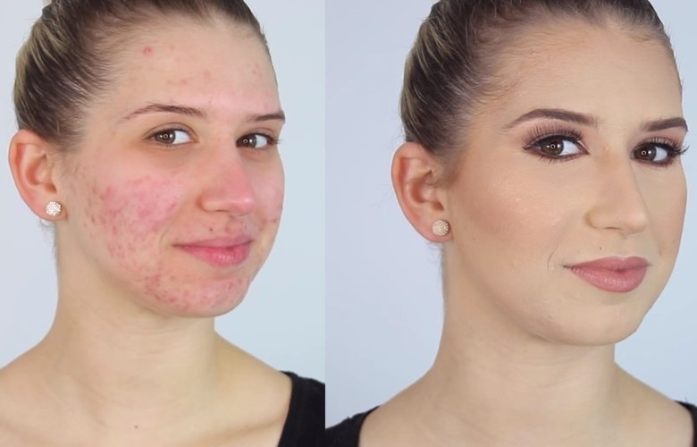Jak wykonać makijaż dla cery trądzikowej?