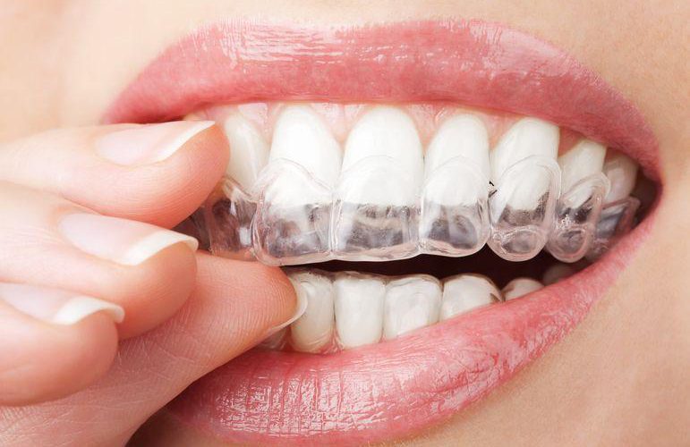 Czy można wybielić zęby domowymi sposobami? Znamy odpowiedź